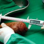 Sri Lanka doctors remove 'world's largest kidney stone'